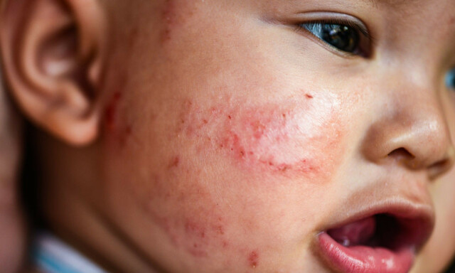 INFISERT EKSEM: Eksempel på eksem med bakterieinfeksjon. Behandles med kombinasjonskremer med kortison og antibakteriell krem. FOTO: NTB scanpix / Shutterstock / Poring Studio INFISERT EKSEM: Eksempel på eksem med bakterieinfeksjon. Behandles med kombinasjonskremer med kortison og antibakteriell krem. FOTO: NTB scanpix / Shutterstock / Poring Studio